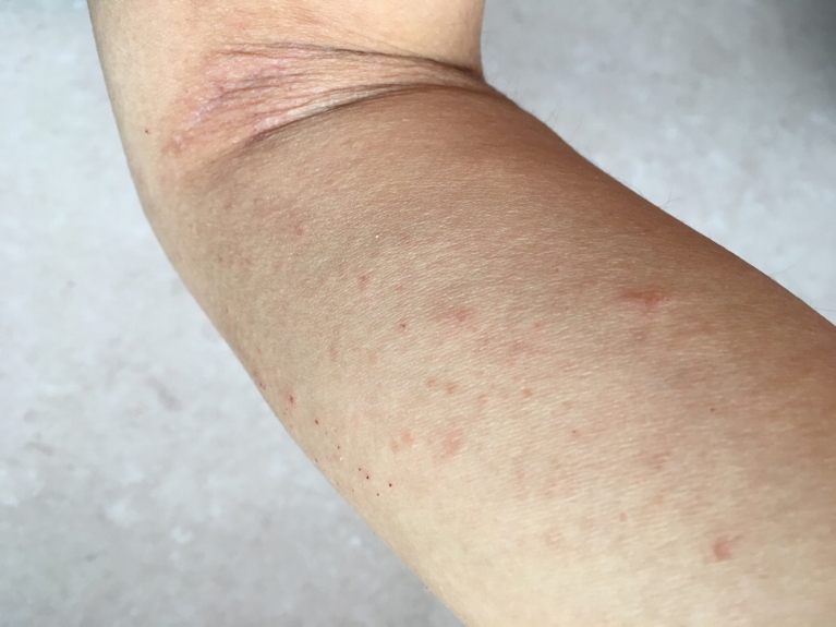 炎 花粉 皮膚 花粉による肌アレルギー症状は花粉皮膚炎かも。対処法と予防法を紹介